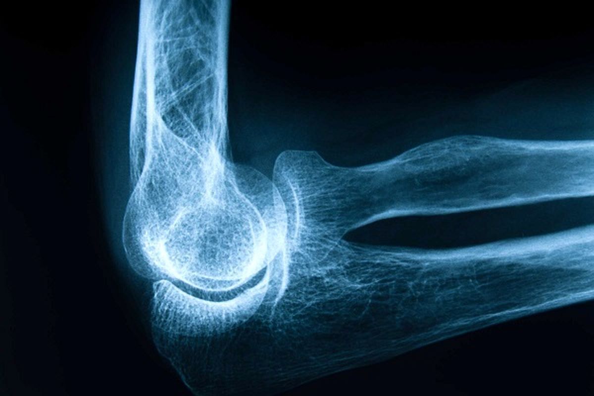 امروز، روز جهانی پوکی استخوان است؛ بیماری پنهانی که اگر امروز جدی‌اش نگیریم، فردا ممکن است ساده‌ترین زمین‌خوردن نیز برایمان هزینه‌ای سنگین داشته باشد.