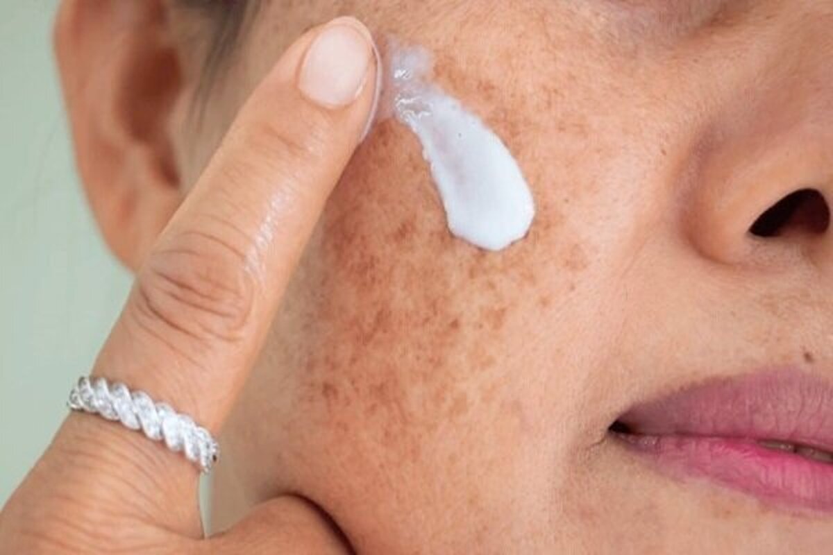 به گفته یک دکترای صلاحیت حرفه‌ای پوست و مو، منافذ باز پوست فقط مخصوص صورت نیستند؛ در نواحی پرچربی مثل پشت، سینه و شانه‌ها هم دیده می‌شوند. اما چون پوست صورت بیشتر در معرض دید و فعالیت غدد سباسه است، منافذ آنجا برجسته‌تر و شایع‌تر به‌نظر می‌رسند.