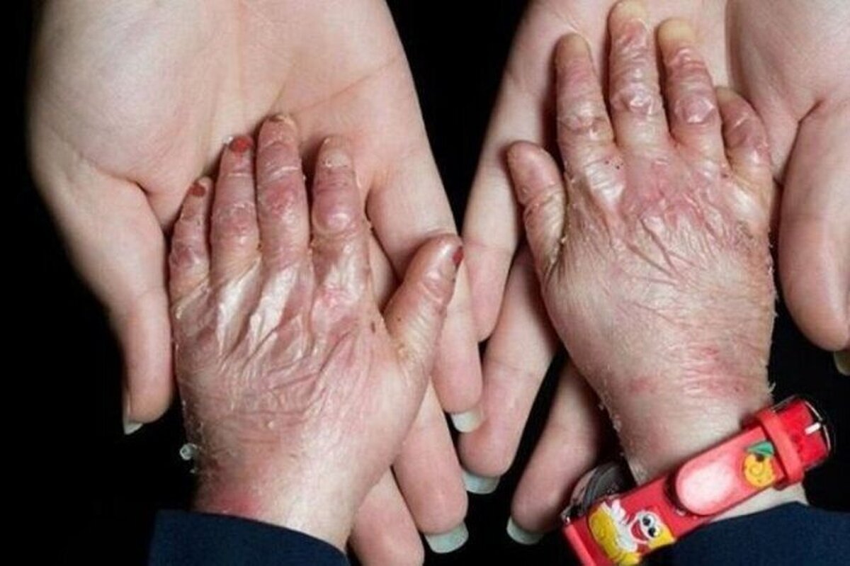 مدیرعامل خانه‌ ای‌بی ایران می‌گوید: ۸۰ درصد بیماران پروانه‌ای برای دریافت خدمات پزشکی مثل جراحی و دندانپزشکی مجبورند به شهر‌های دیگر سفر کنند.