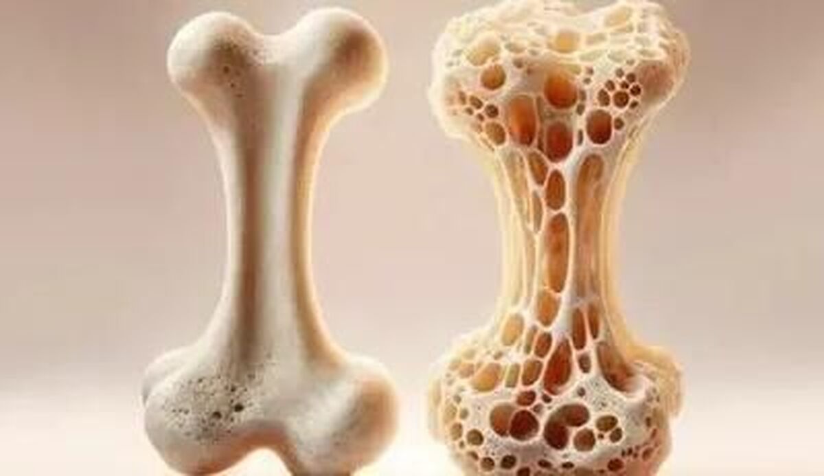 یک فوق‌تخصص روماتولوژی گفت: افرادی که به هر علت عمل هیسترکتومی (برداشت رحم) یا برداشت تخمدان داشته‌اند و همچنین بیمارانی که شیمی‌درمانی انجام داده‌اند، مستعد ابتلا به پوکی استخوان هستند.