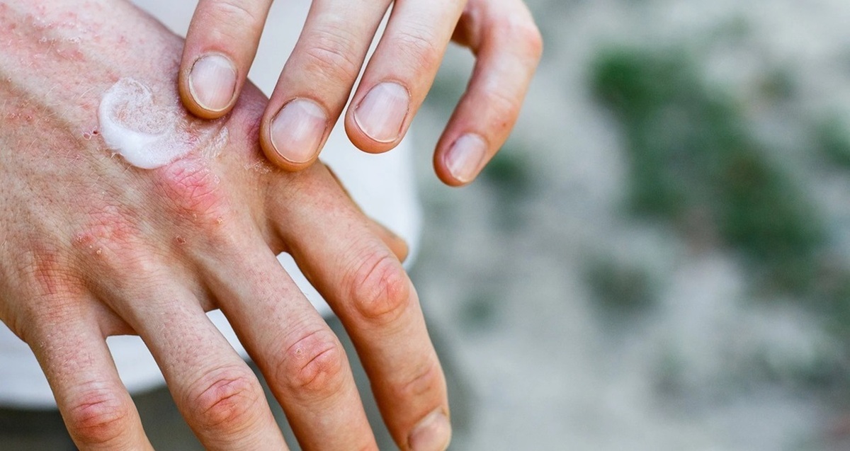 اگرچه پوست، مهمترین و مقاوم‌ترین لایه محافظتی بدن انسان است که بیشترین ارتباط را با محیط اطراف دارد، اما آب و هوا در فصول سرد سال خصوصاً پاییز به شکلی است که منجر به خشکی پوست می‌شود.