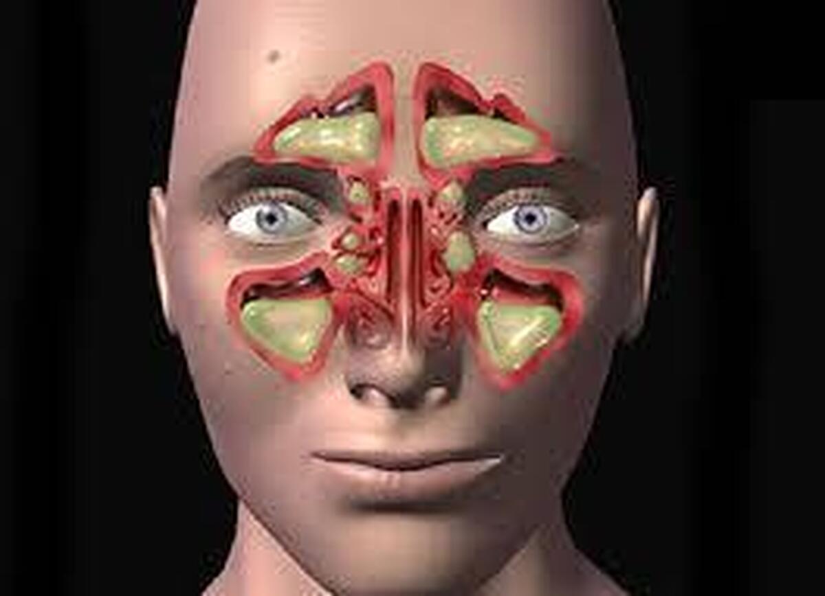 یک فلوشیپ اندوسکوپی بینی و سینوس گفت: در روز‌هایی که شاخص آلودگی هوا ناسالم است، بیماران مبتلا به سینوزیت باید مراقبت‌های روزانه خود را جدی دنبال کنند تا از تشدید علائم جلوگیری شود.