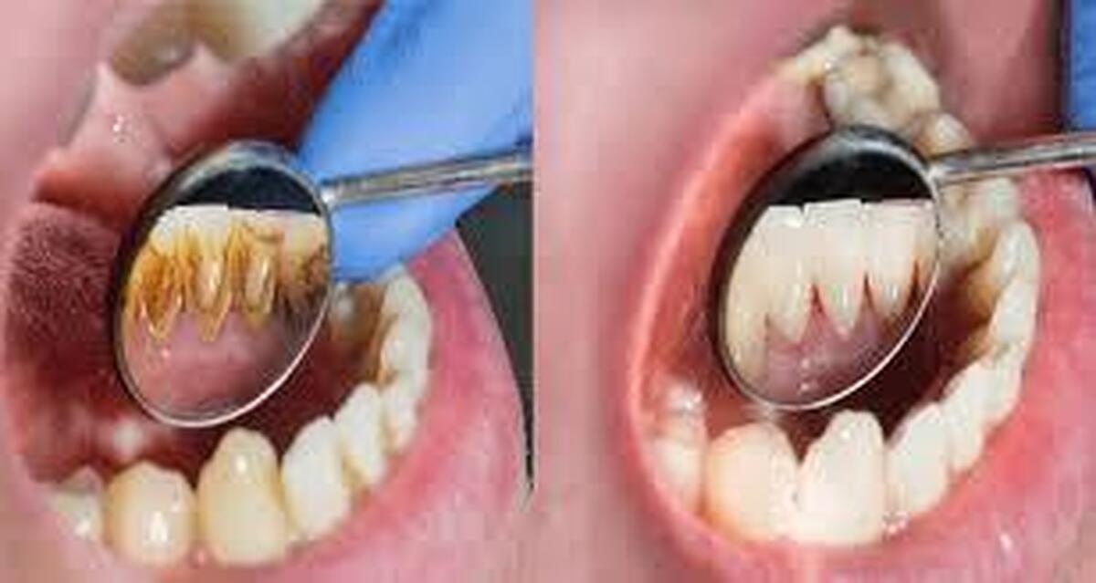 بسیاری از افراد تصور می‌کنند جرم‌گیری فقط باعث خراب شدن دندان‌ها و زخم شدن لثه می‌شود و انجام آن لزومی ندارد و حتی به دندان‌ها و لثه‌ها آسیب می‌رساند.