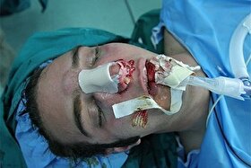 جراحی بینی بدون بیهوشی توسط دستیار دیپلمه پزشک مدعی!