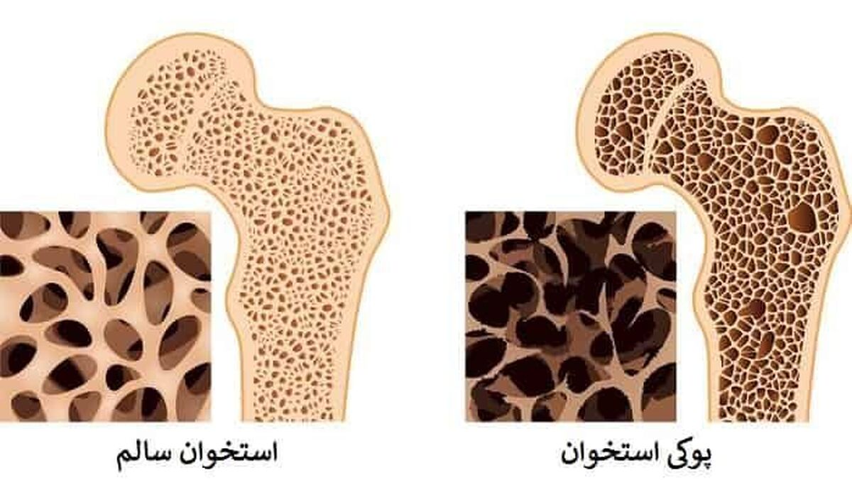 یائسگی زودرس، عامل مهم در ابتلای زنان به پوکی استخوان