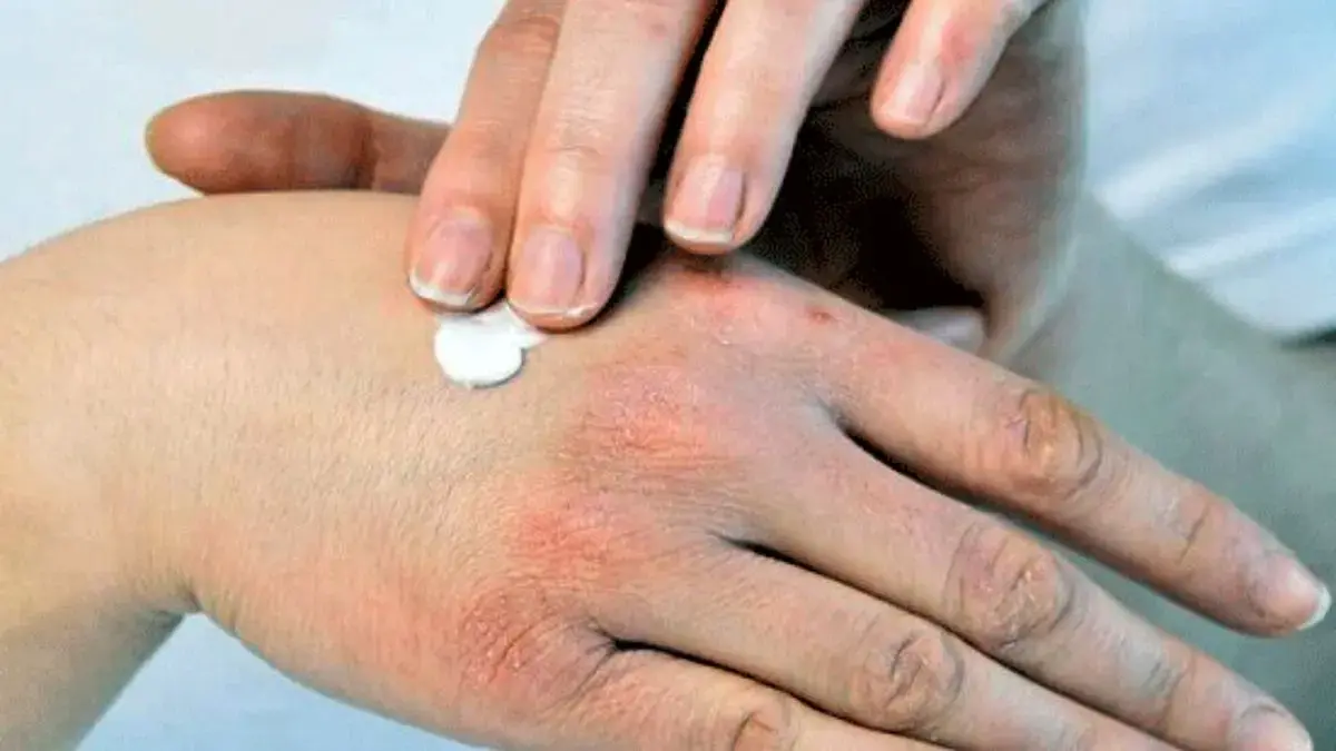 هشدار طب سنتی: افزایش مشکلات پوستی در فصل بهار