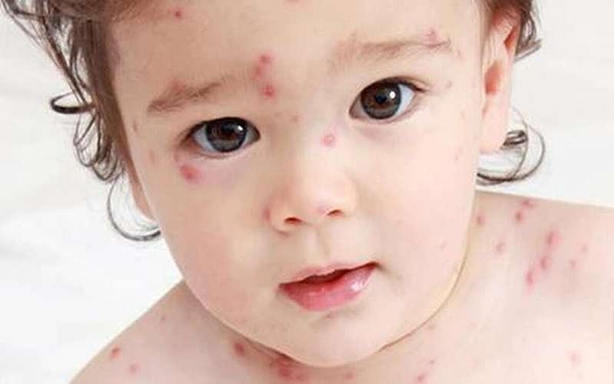 آنچه والدین باید درباره آبله‌مرغان و زونا بدانند