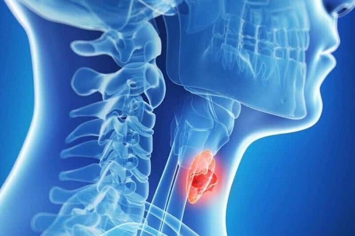هشدار جدی یک متخصص غدد به بیماران تیروئیدی