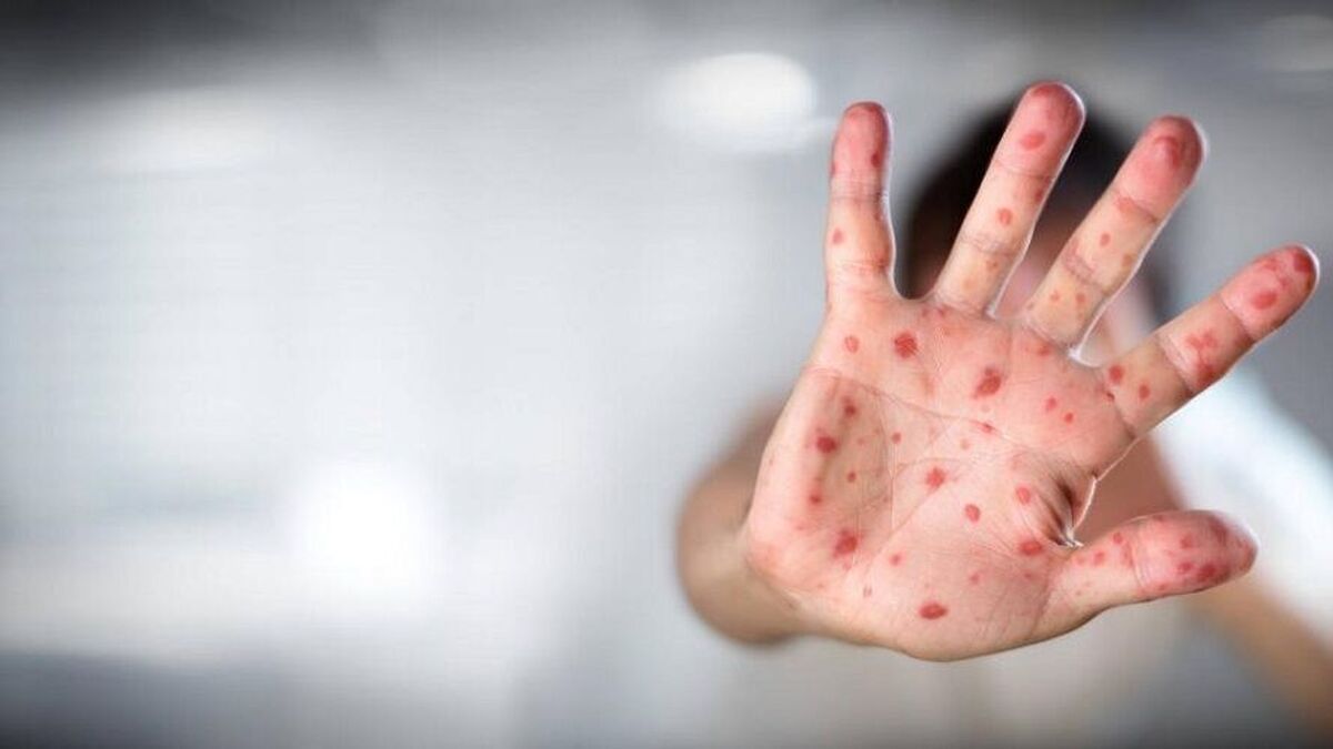 مادران باردار بخوانند| خطرات تماس با بیمار مبتلا به آبله مرغان