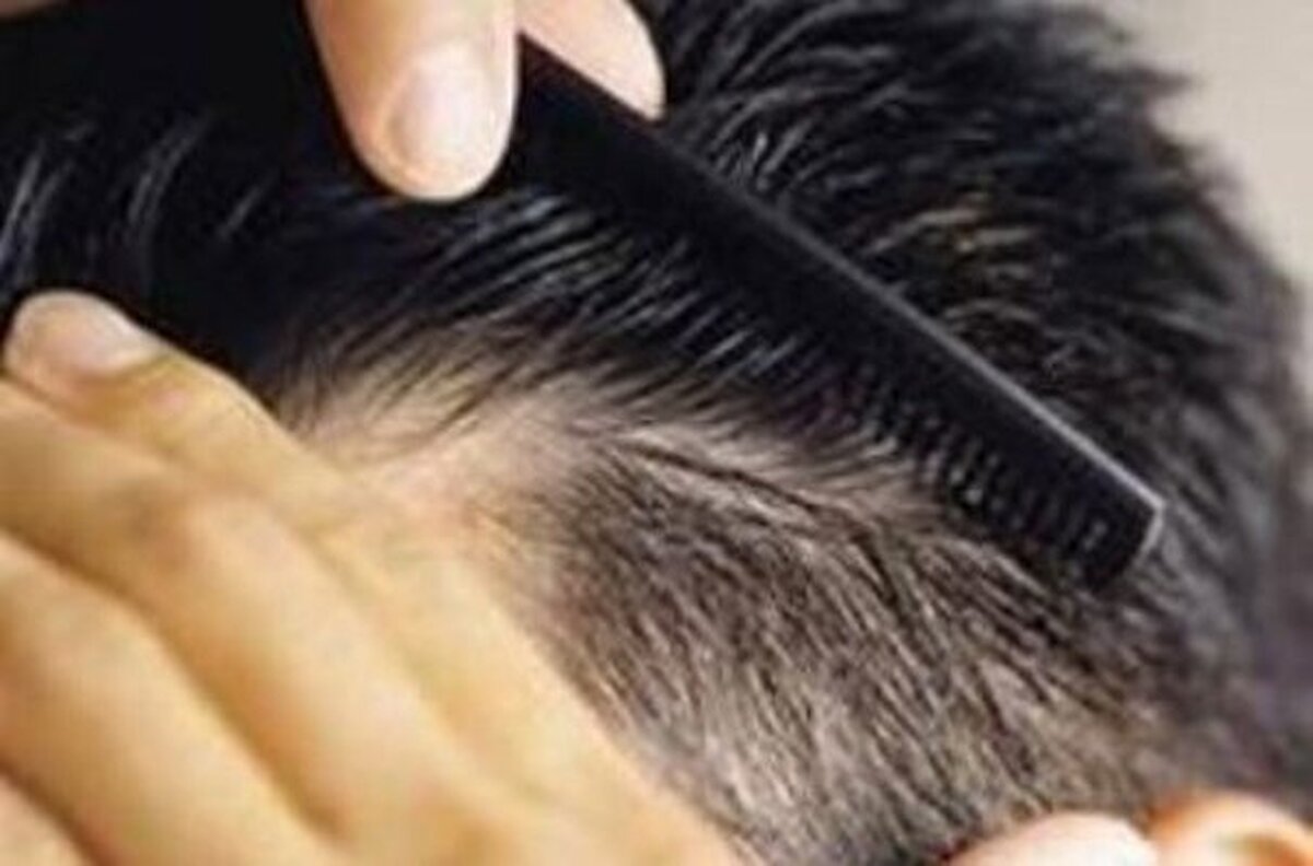 پژوهشگران مشهدی فرمولاسیون درمان شایع‌ترین نوع ریزش مو را طراحی کردند