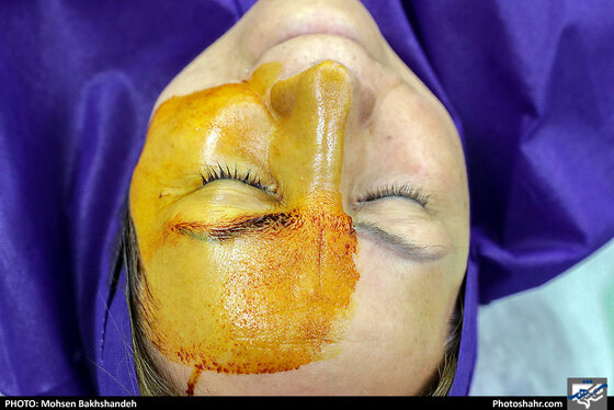 عمل جراحی سنتو لیزر در بیمارستان بینا - عکس : محسن بخشنده / شهرآرا